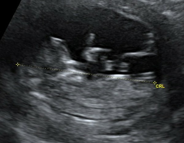 Do you want me to guess the sex? 12 week scans.