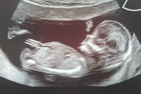 Do you want me to guess the sex? 12 week scans.