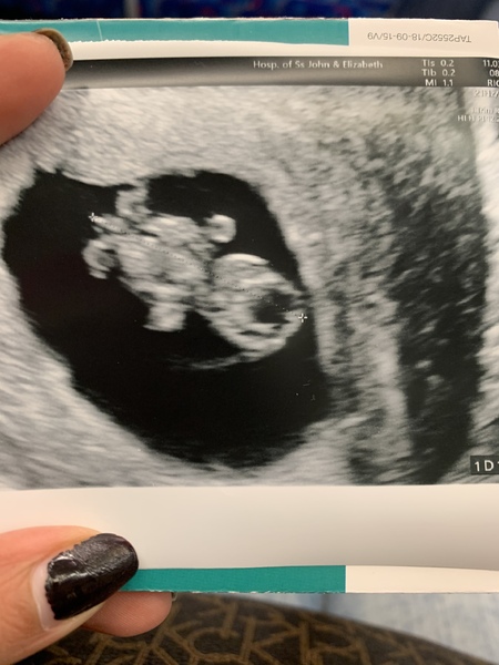 Pregnancy after loss - Autumn babies 2021 - Thread 2