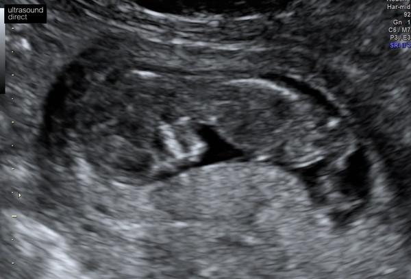 Another Nub Thread! 12 Week Scan