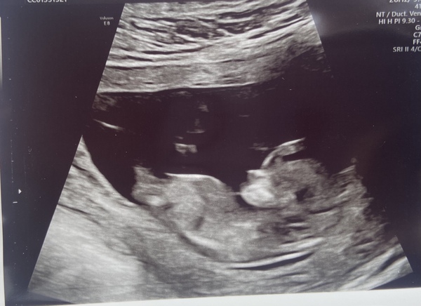 12 week scan - any guesses?