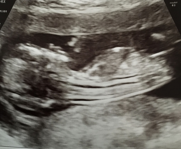 Do you want me to guess the sex? 12 week scans.