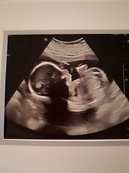 Boy or girl scan (Just for fun!)