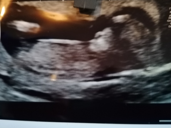 Do you want me to guess the sex? 12 week scans.