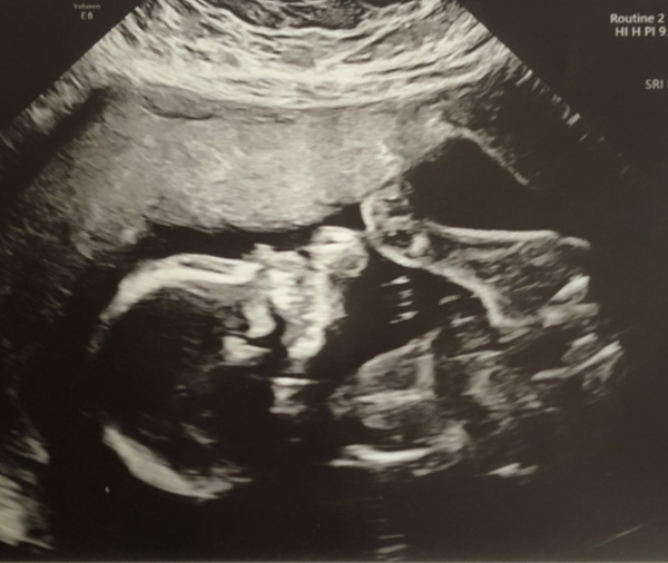 Do you want me to guess the sex? 12 week scans.