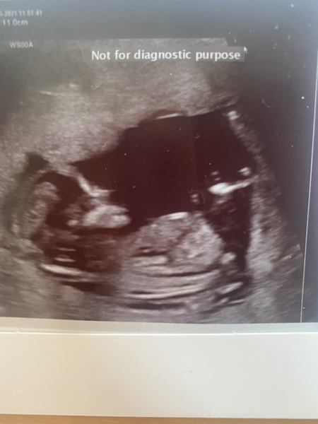 Boy or girl? 13 week scan!☺️