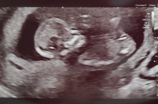 Do you want me to guess the sex? 12 week scans.