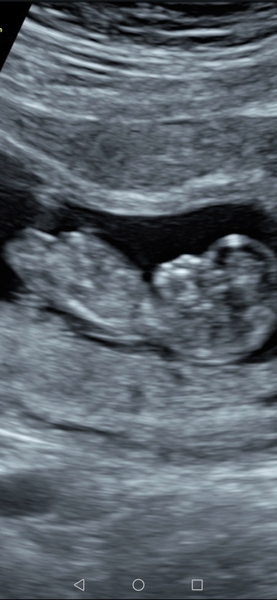 Do you want me to guess the sex? 12 week scans.