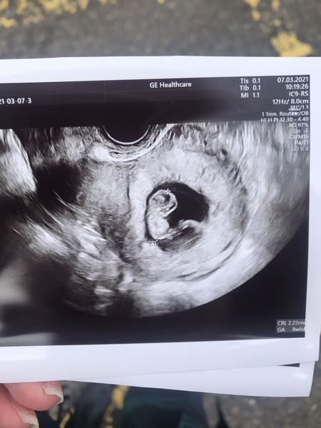 Pregnancy after loss - Autumn babies 2021