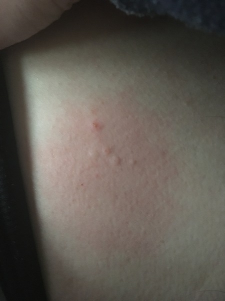 Are these hives?