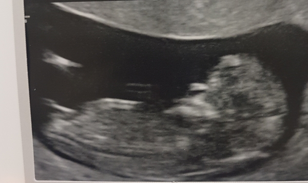 Do you want me to guess the sex? 12 week scans.