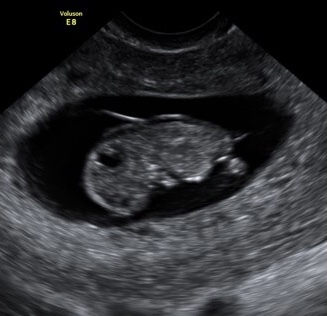 9 weeks 3 days nuchal fold looks enlarged