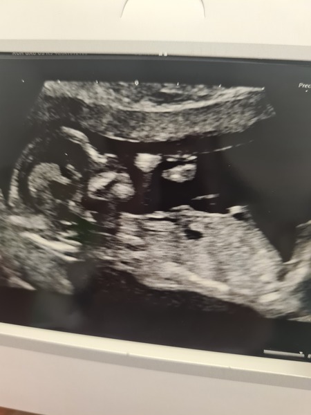 Do you want me to guess the sex? 12 week scans.