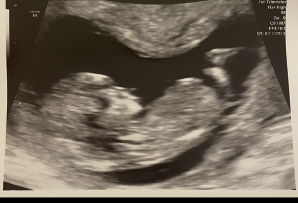 Do you want me to guess the sex? 12 week scans.