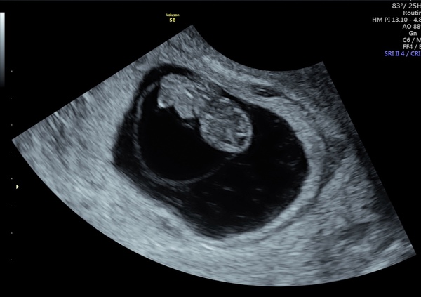 Pregnancy after loss - Autumn babies 2021 - Thread 2