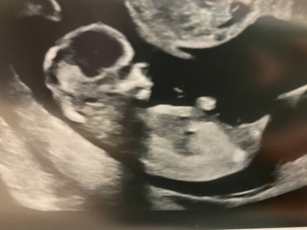 Pregnancy after loss - Autumn babies 2021 - Thread 2