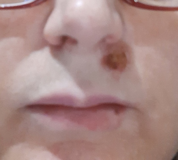 Mask wearing and coldsores