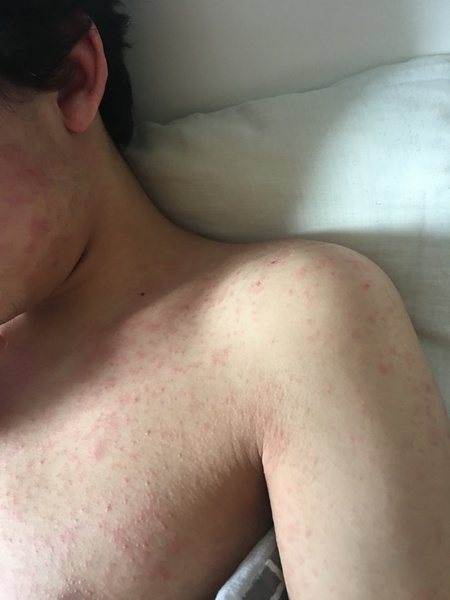 What do you reckon measles, rubella or allergic reaction?
