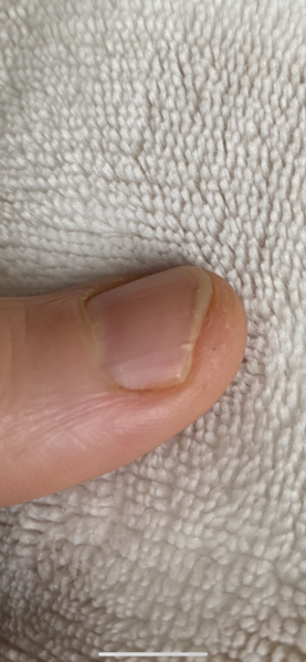 Wtf is going on with my nail, it's pissing me off. *pic*