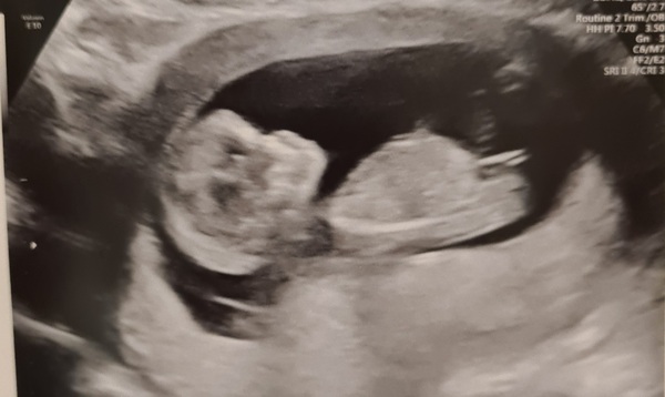 Do you want me to guess the sex? 12 week scans.