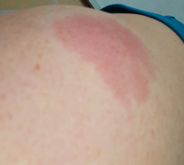 Spreading heat and redness on arm around area of vaccination