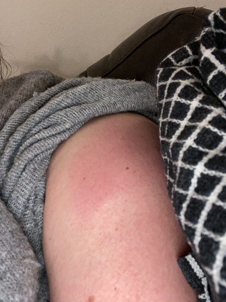AstraZeneca vaccine - really sore, swollen arm 4 days on
