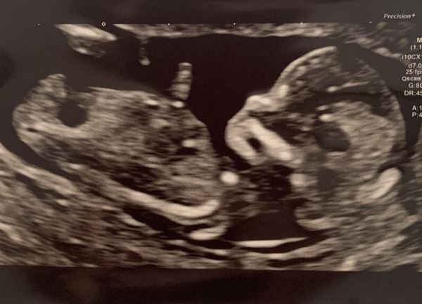 Gender predictions? 13 weeks ☺️