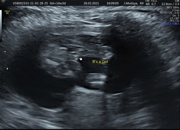 Gender scan unsure! Pic attached