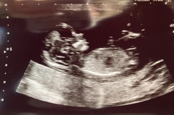 Boy or Girl?