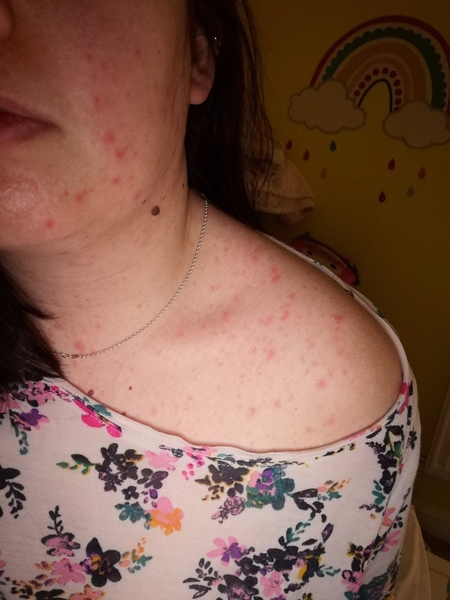 Long Covid support thread