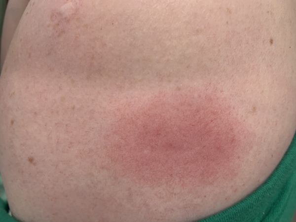 Ugh had the vaccine this morning and now running a fever, feeling sick and generally ygh