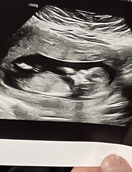 13 week scan gender guess?