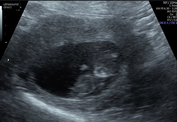 Pregnancy after loss - Autumn babies 2021