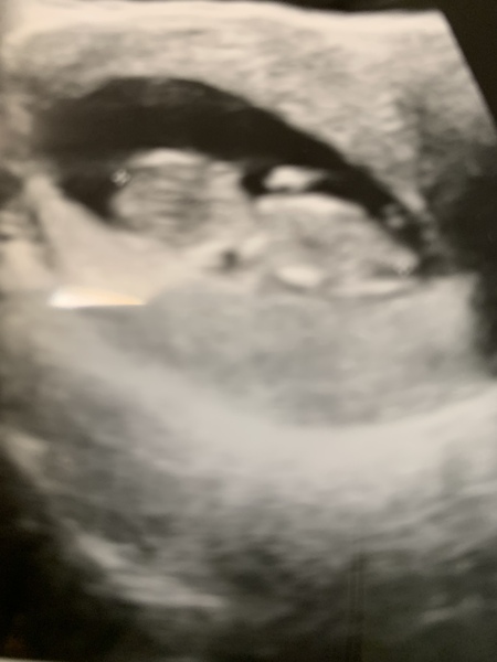 Pregnancy after loss - Autumn babies 2021 - Thread 2