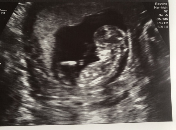 Pregnancy after loss - Autumn babies 2021 - Thread 2