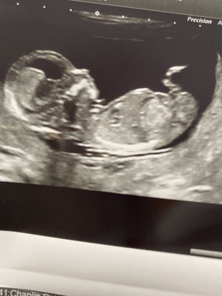 Do you want me to guess the sex? 12 week scans.
