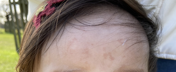 Daughters forehead issue