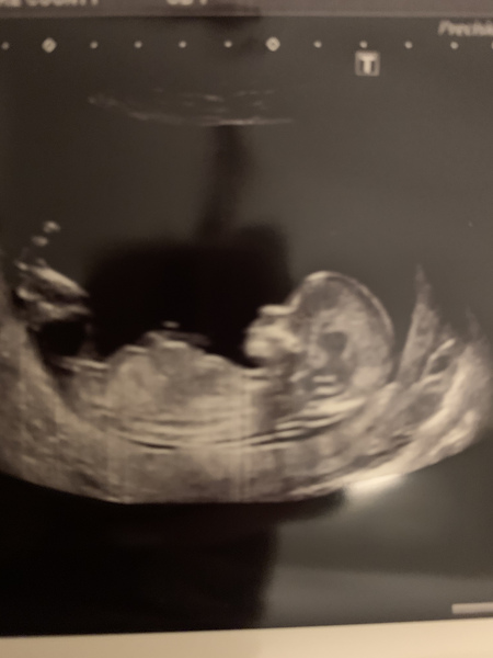 Guess the gender- 13 week 5 day scan cheer me up!