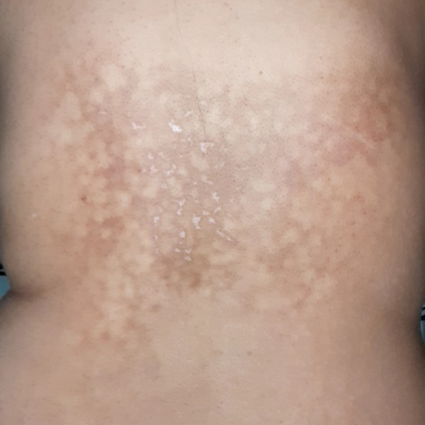 Rash on back