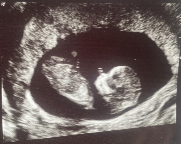 Do you want me to guess the sex? 12 week scans.