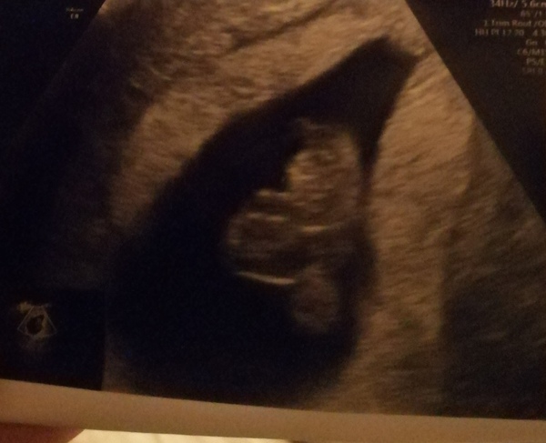 Pregnancy after loss - Autumn babies 2021 - Thread 2