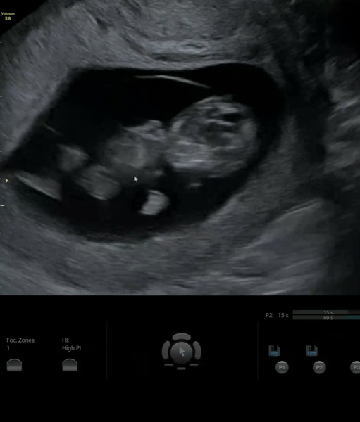 Tracking your cycle and possible BFP using RHR - part 5