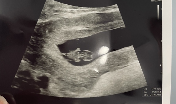 Pregnancy after loss - Autumn babies 2021 - Thread 2