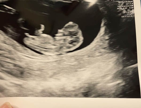 Pregnancy after loss - Autumn babies 2021 - Thread 2