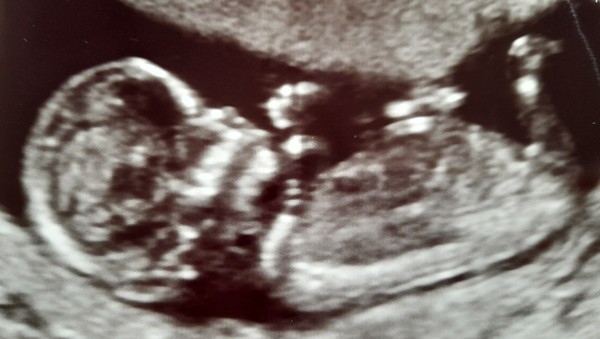 High Risk for Down Syndrome/Edwards-Positive Stories needed please!