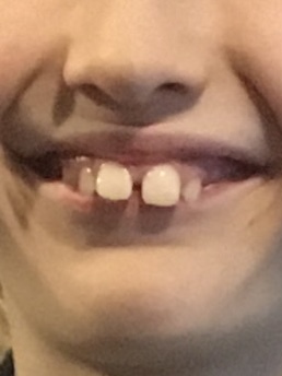 Twin Block Braces - Any Advice?
