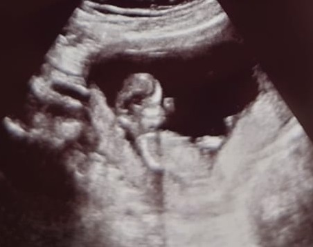 Pregnancy after loss - Autumn babies 2021 - Thread 2