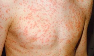 What do you reckon measles, rubella or allergic reaction?
