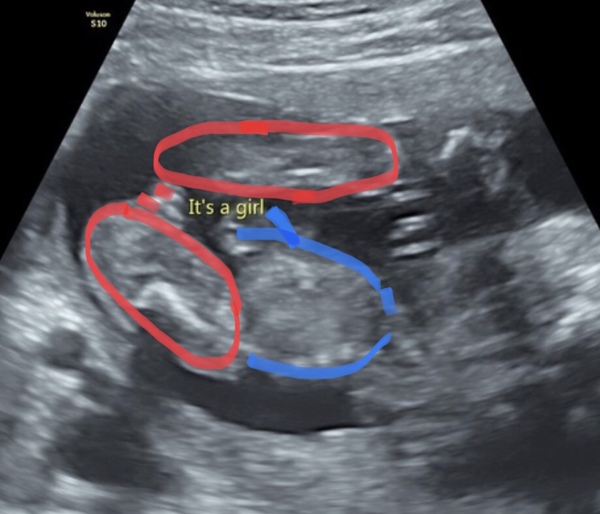What am I looking at on gender scan?