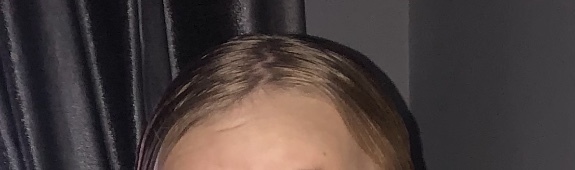 My baby dented her forehead on the skirting board. I am so upset. Pic included.